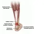 Achilles tendonitis treatment which I wish I knew about during marathon training.