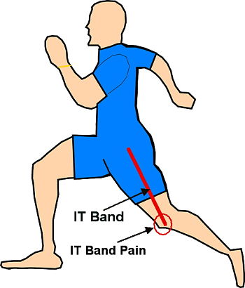 ITB Syndrome and how to cure it fast