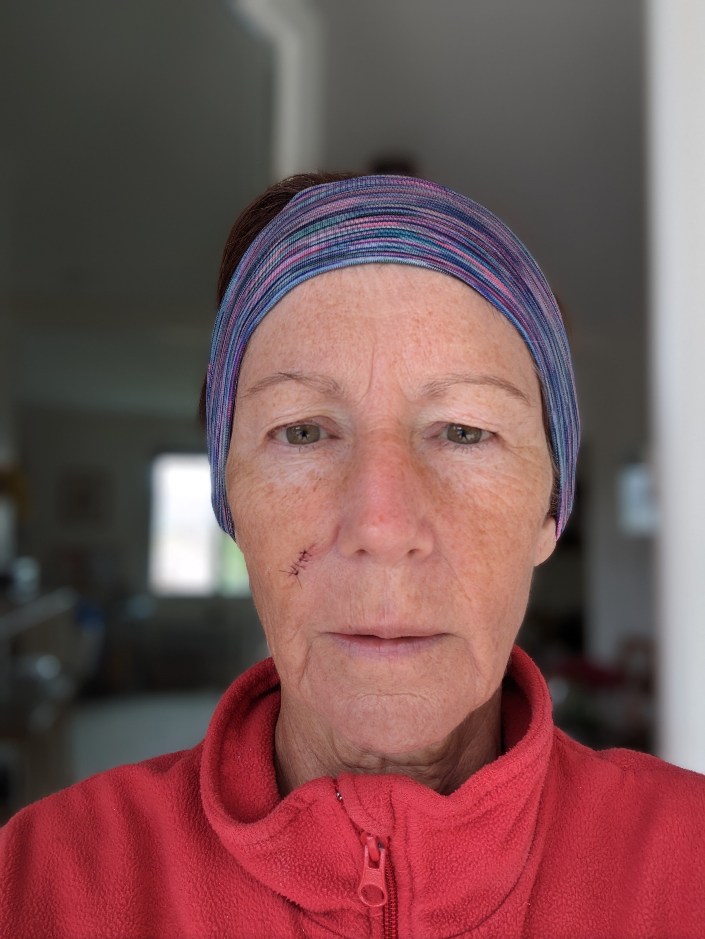 basal cell carcinoma removal from cheek