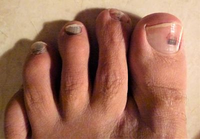 Suffering with Black Toe Nails or Runners Toe?